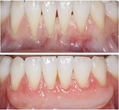 an image of a before and after photo of a gum grafting procedure