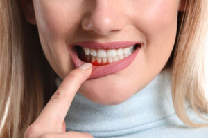 a laser gum treatment patient with sore gums showing her swollen gumline.