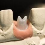 image of a zirconia post model in a model jawbone, which can show patients what their zirconia dental implant will look like in their jawbone.