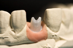 image of a zirconia post model in a model jawbone, which can show patients what their zirconia dental implant will look like in their jawbone.