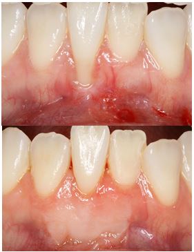 progress photo of a patients teeth