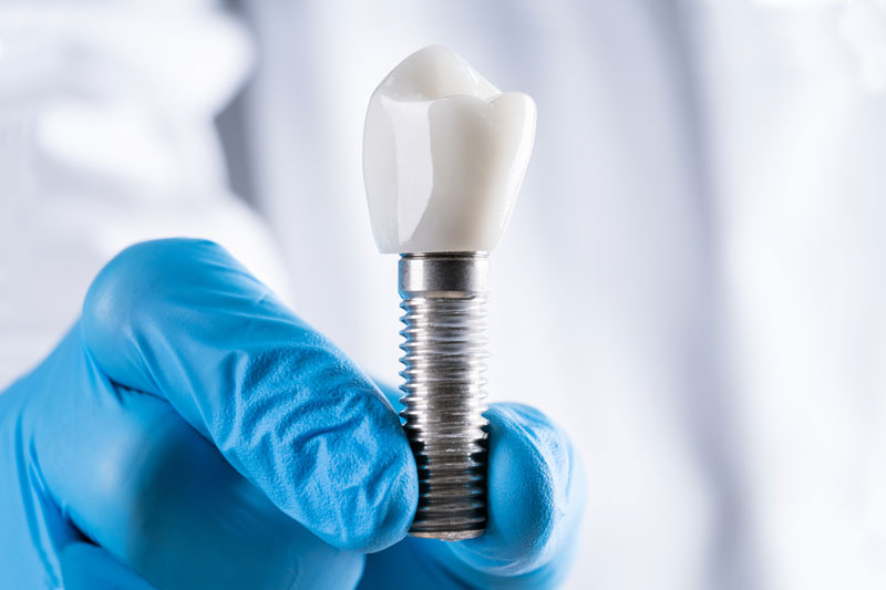 Dentist Holding Up A Single Dental Implants